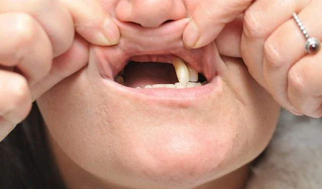 Nằm mơ thấy rụng răng có bình thường không? Giải Thích Giấc Mơ - Phòng Khám Nha Khoa Parkway